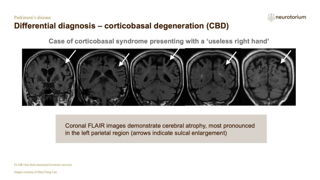 Differential diagnosis – corticobasal degeneration (CBD)